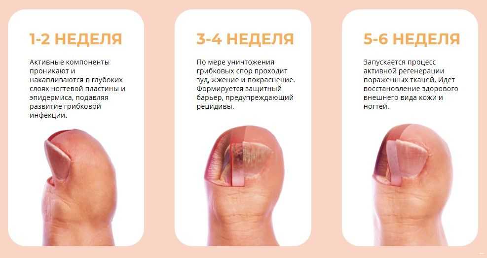 Грибок ногтей на ногах: лечение, стадии, причины