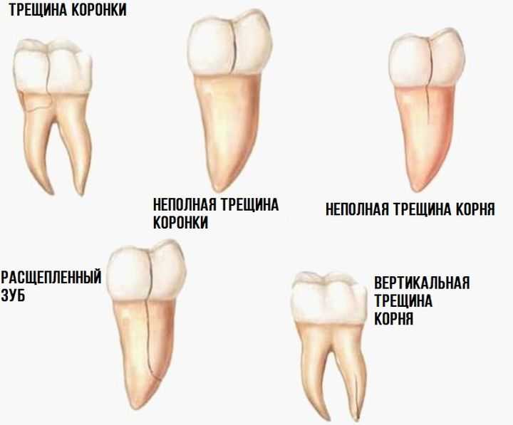 К чему снятся гнилые зубы во рту у себя