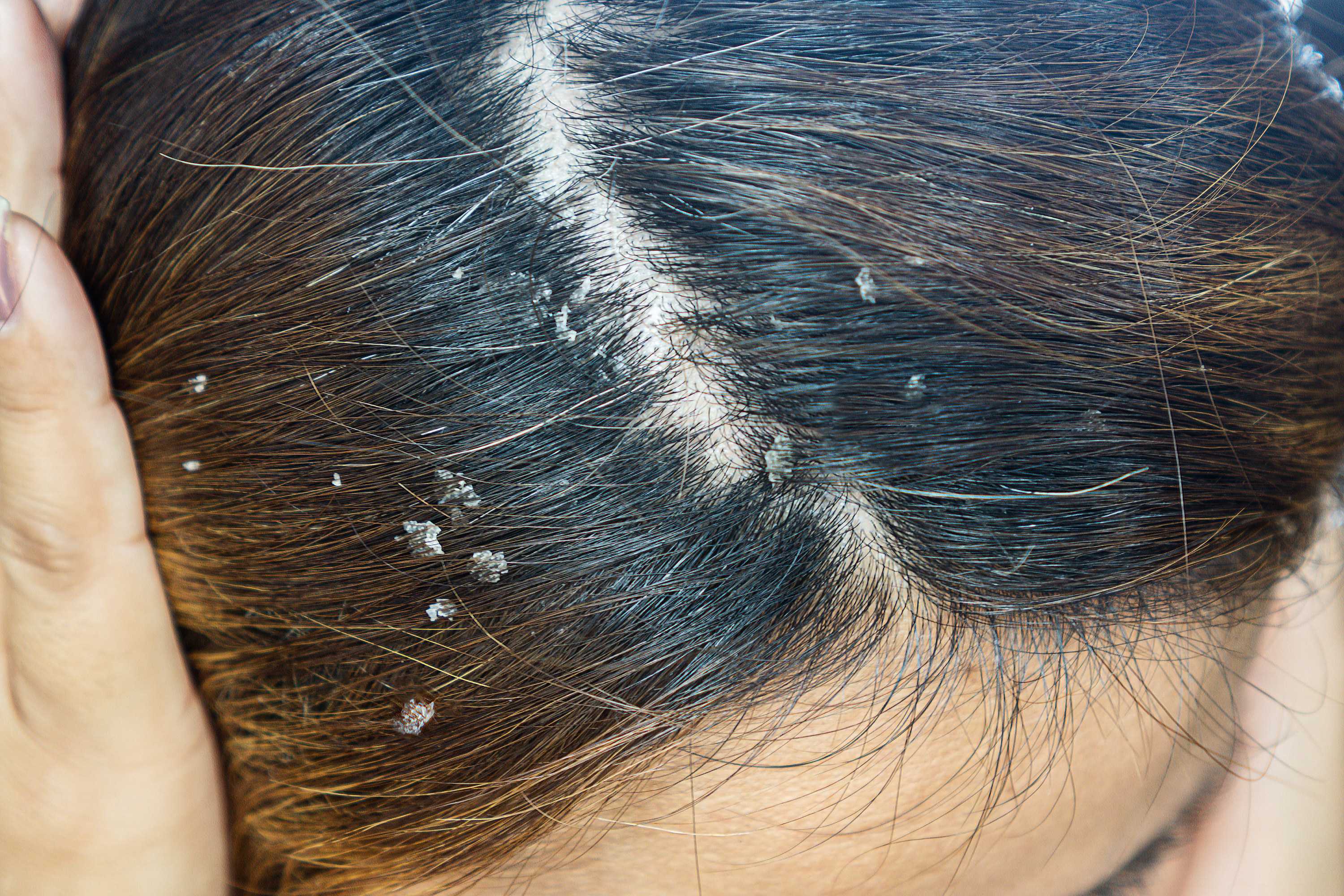 Как лечить волосы на голове от белых волос