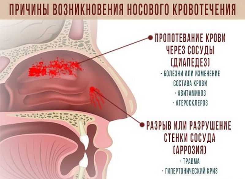 На каком из рисунков наиболее правильно показан метод остановки кровотечения из носа