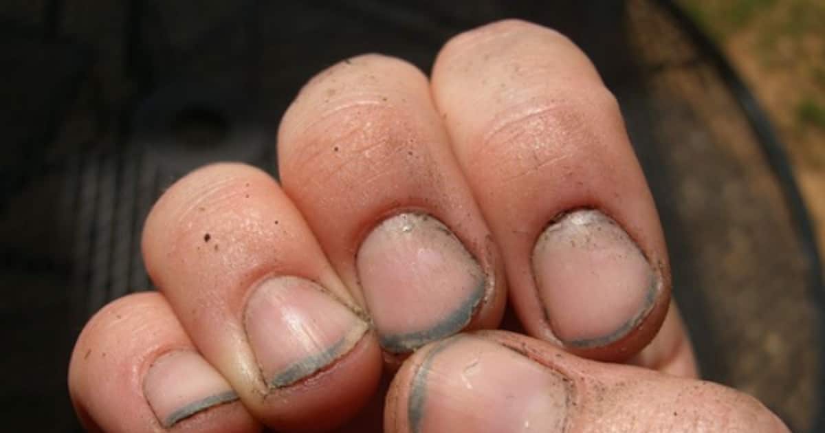 Состояние ногтей гласит о общем здоровье человека Если ногти ломаются либо меняют форму, означает, происходят патологические конфигурации в организме Что